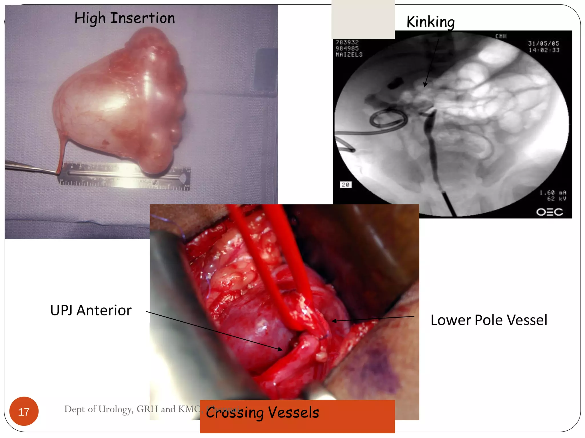 Lower Pole Vessel
UPJ Anterior
High Insertion Kinking
Crossing Vessels
17 Dept of Urology, GRH and KMC, Chennai.
 