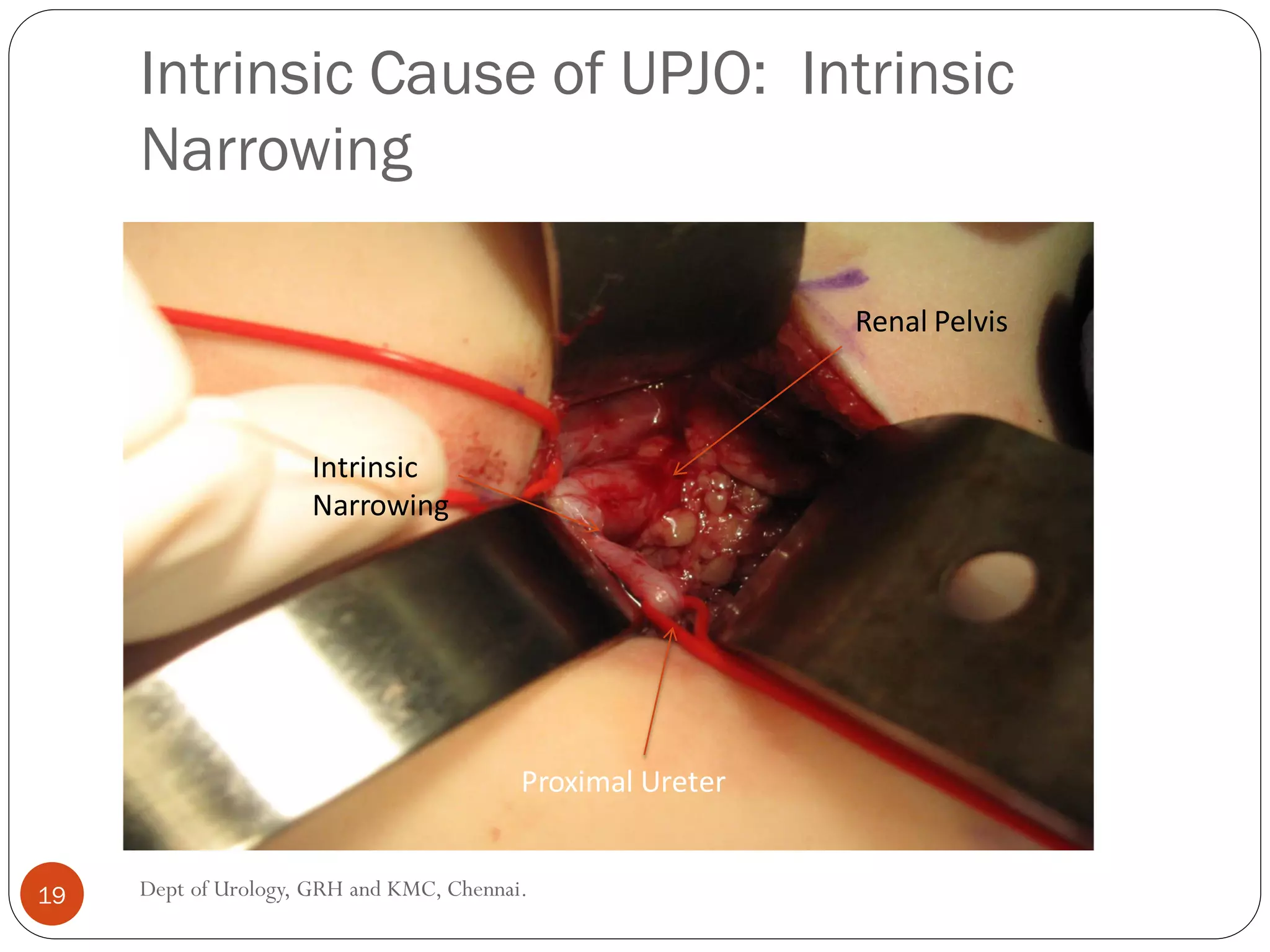 Intrinsic Cause of UPJO: Intrinsic
Narrowing
Renal Pelvis
Proximal Ureter
Intrinsic
Narrowing
19 Dept of Urology, GRH and KMC, Chennai.
 