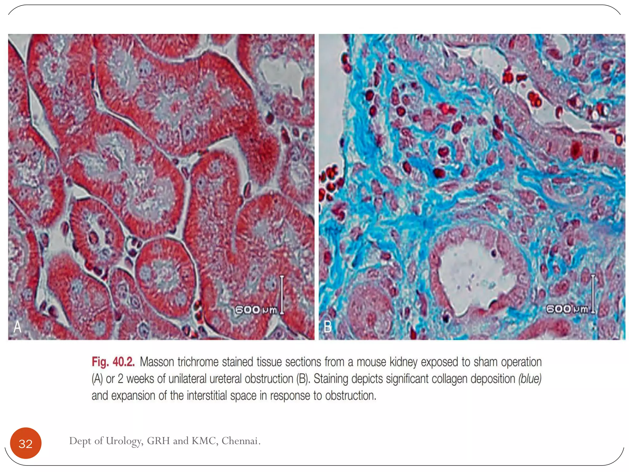 32 Dept of Urology, GRH and KMC, Chennai.
 