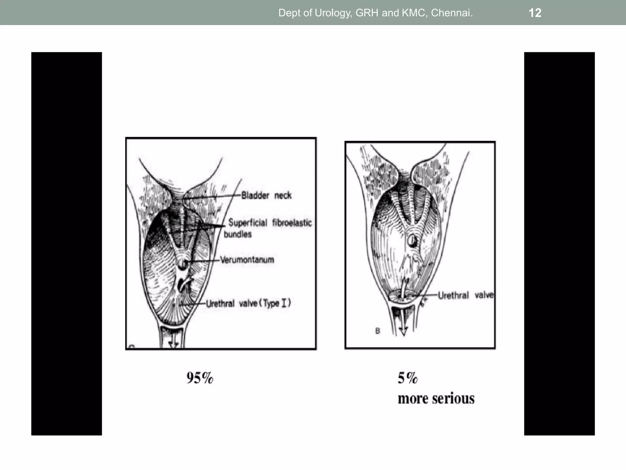 Puv Size Pediatric urology :Posterior Urethral Valve (PUV)- diagnosis ...