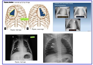Comprehensive Pediatric Radiology: Chest and Cardiac X-Ray ...