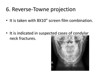 6. Reverse-Towne projection
• It is taken with 8X10” screen film combination.
• It is indicated in suspected cases of condylar
neck fractures.
 
