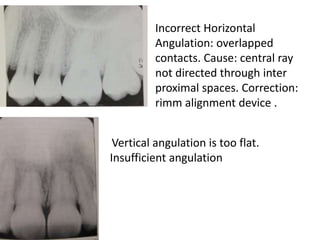 Incorrect Horizontal
Angulation: overlapped
contacts. Cause: central ray
not directed through inter
proximal spaces. Correction:
rimm alignment device .
Vertical angulation is too flat.
Insufficient angulation
 