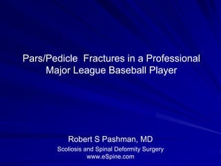 Pars/Pedicle Fractures in a Professional
Major League Baseball Player
Robert S Pashman, MD
Scoliosis and Spinal Deformity Surgery
www.eSpine.com
 