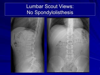 Lumbar Scout Views:
No Spondylolisthesis
 