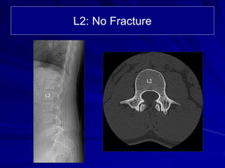 L2: No Fracture
L2
L2
 