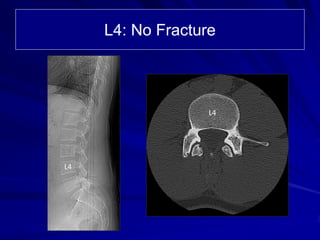 L4: No Fracture
L4
L4
 
