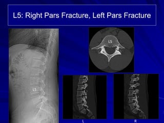 L5: Right Pars Fracture, Left Pars Fracture
RL
L5
L5
 