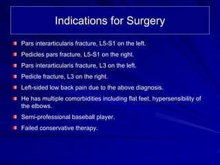 Indications for Surgery
Pars interarticularis fracture, L5-S1 on the left.
Pedicles pars fracture, L5-S1 on the right.
Pars interarticularis fracture, L3 on the left.
Pedicle fracture, L3 on the right.
Left-sided low back pain due to the above diagnosis.
He has multiple comorbidities including flat feet, hypersensibility of
the elbows.
Semi-professional baseball player.
Failed conservative therapy.
 