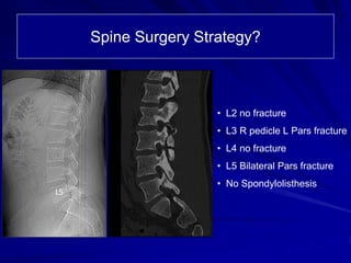 Spine Surgery Strategy?
L5
• L2 no fracture
• L3 R pedicle L Pars fracture
• L4 no fracture
• L5 Bilateral Pars fracture
• No Spondylolisthesis
 