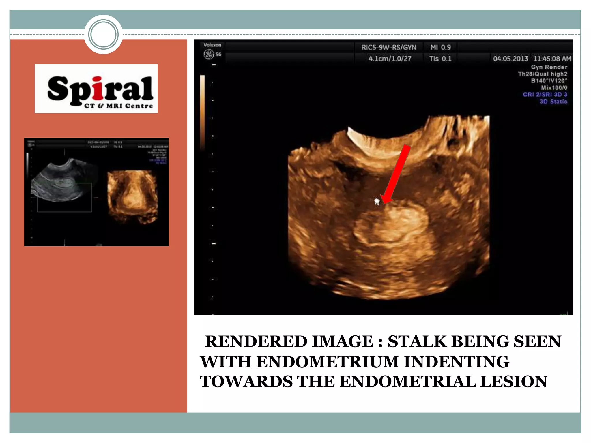 Pedicle artery sign | PPT