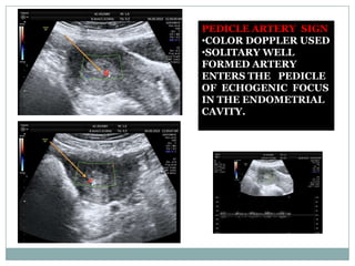 Pedicle artery sign | PPTX