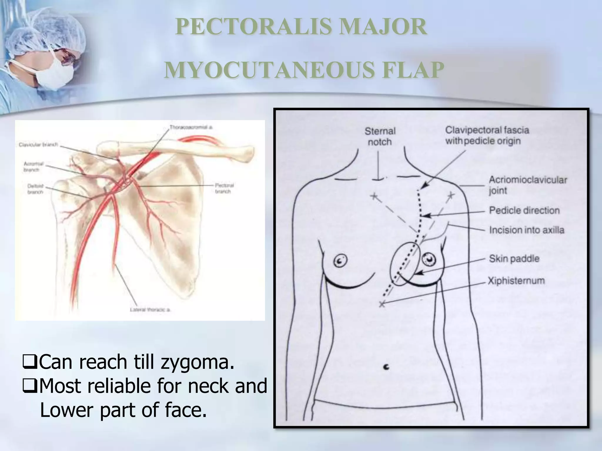 Pedicle Flaps Example scope of Pedicled flaps in oral and maxillofacial surgery | PPTX