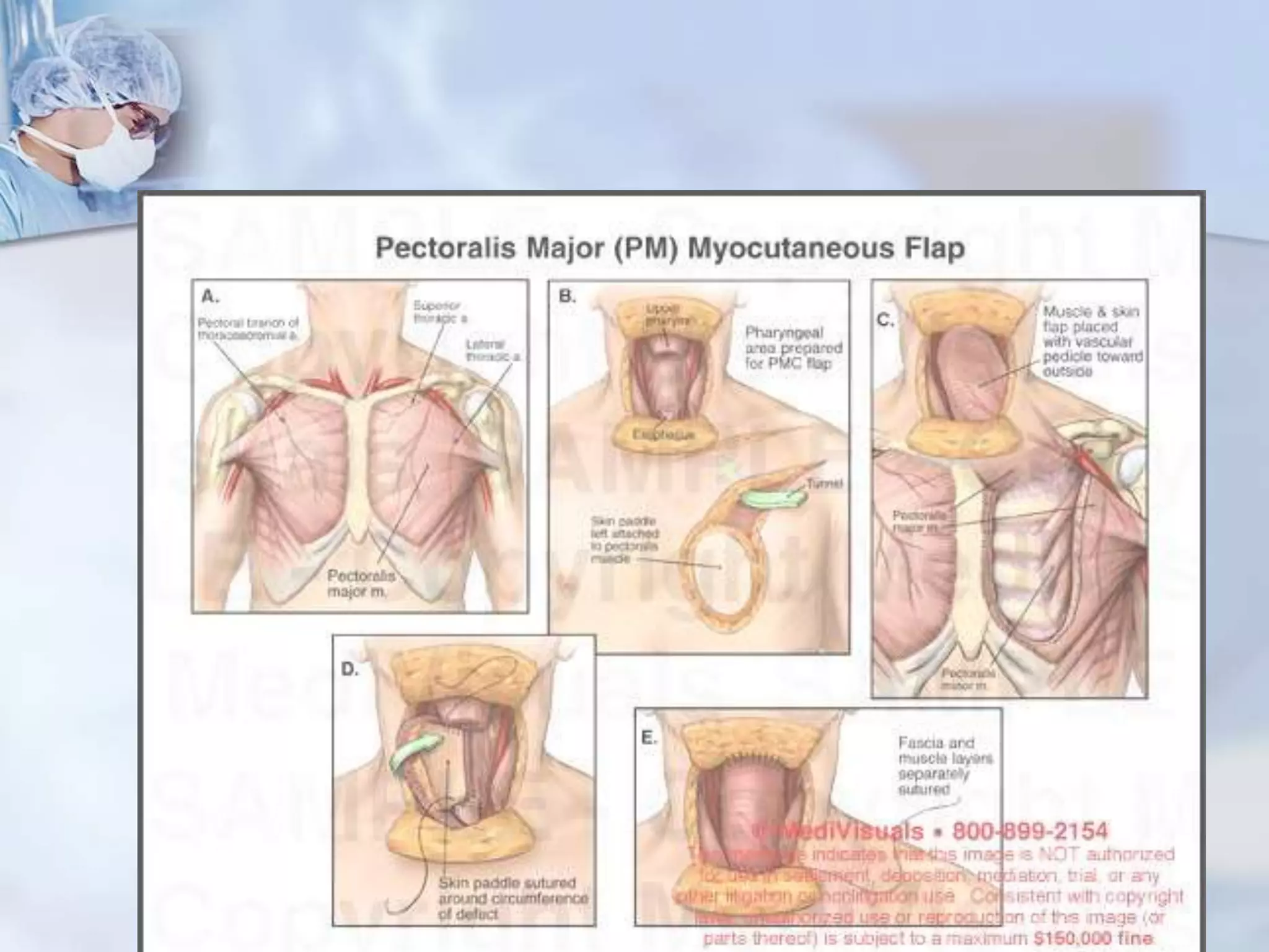 Pedicle Flaps Example scope of Pedicled flaps in oral and maxillofacial surgery | PPTX
