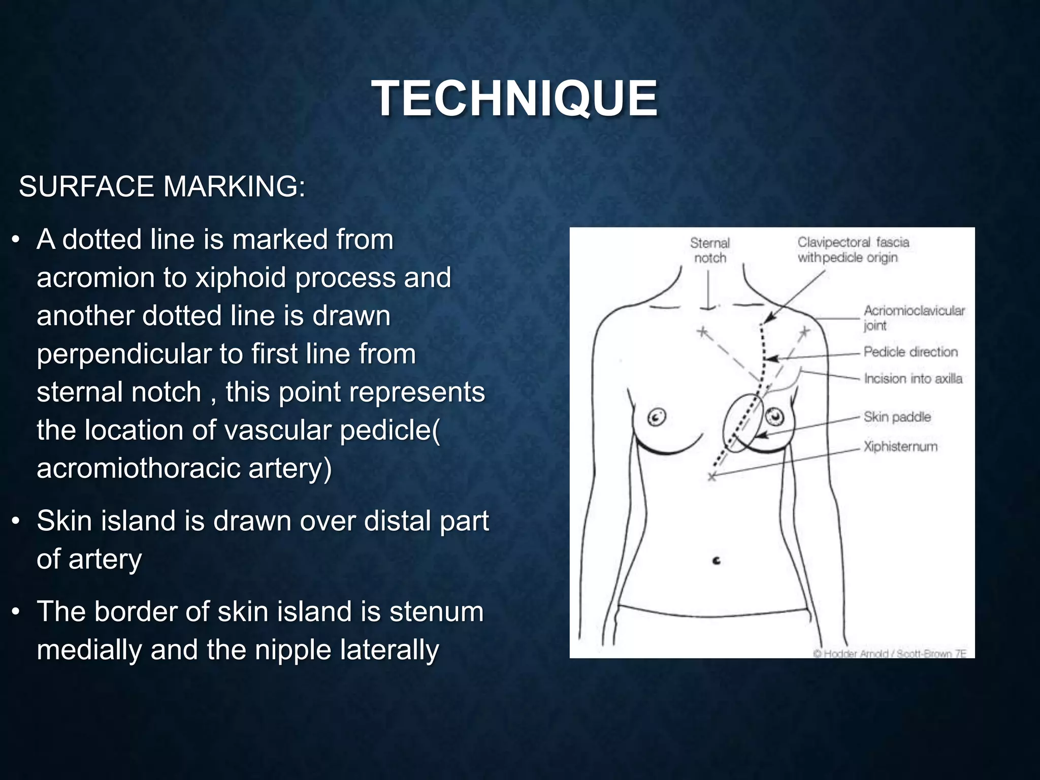 Pedicle Flaps Example Pedicled flaps in head and neck surgery | PPTX