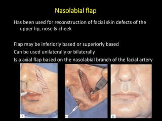 Pedicle Flaps Example Pedicle flap in Maxillofacial Surgery | PPTX