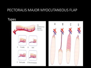 Pedicle Flaps Example Pedicle flap in Maxillofacial Surgery | PPTX