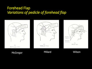 Pedicle Flaps Example Pedicle flap in Maxillofacial Surgery | PPTX