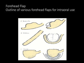 Pedicle Flaps Example Pedicle flap in Maxillofacial Surgery | PPTX