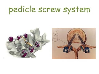 pedicle screw system
 