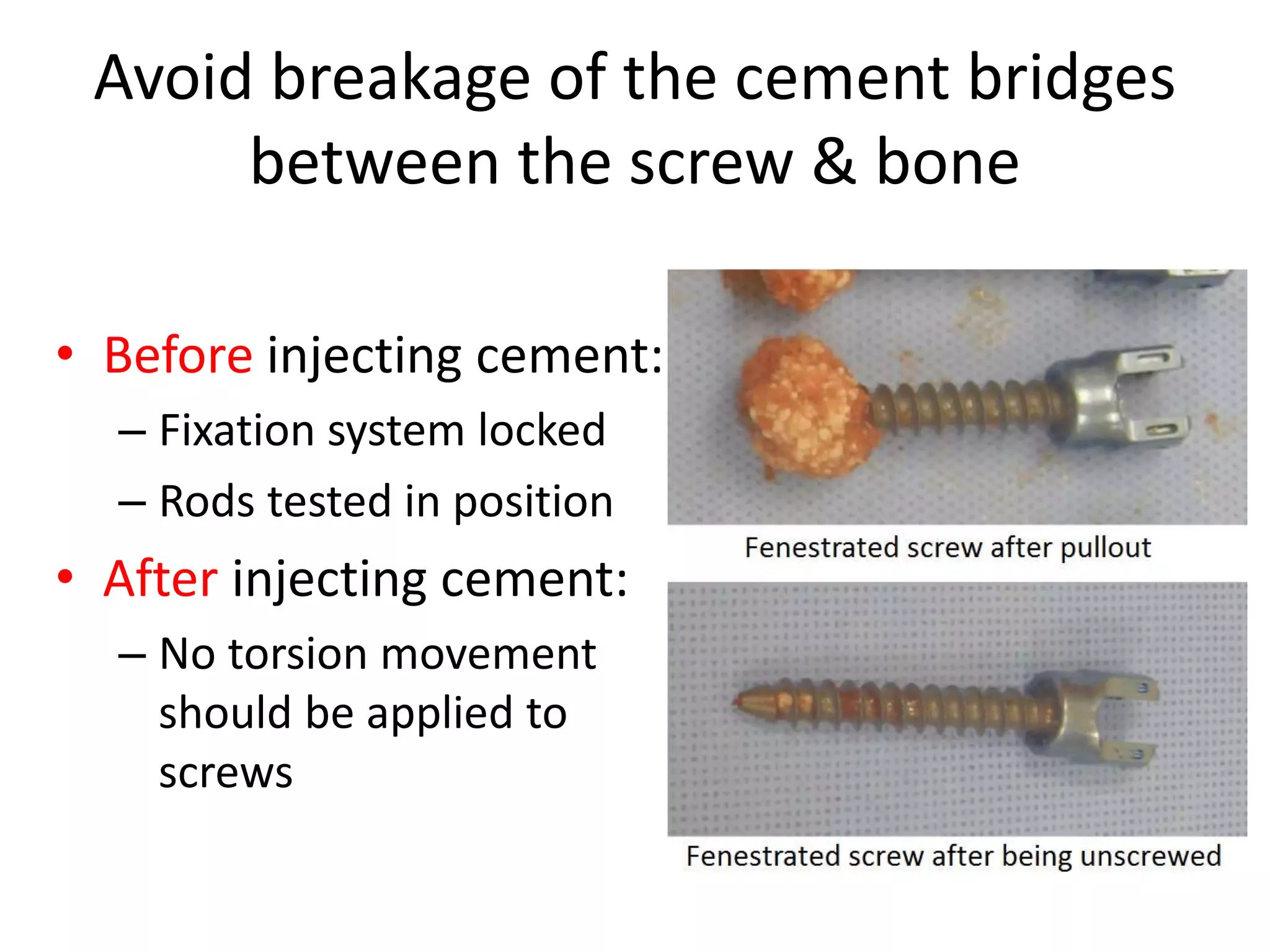 Pedicle screw fixation in osteoporotic fractures | PPTX