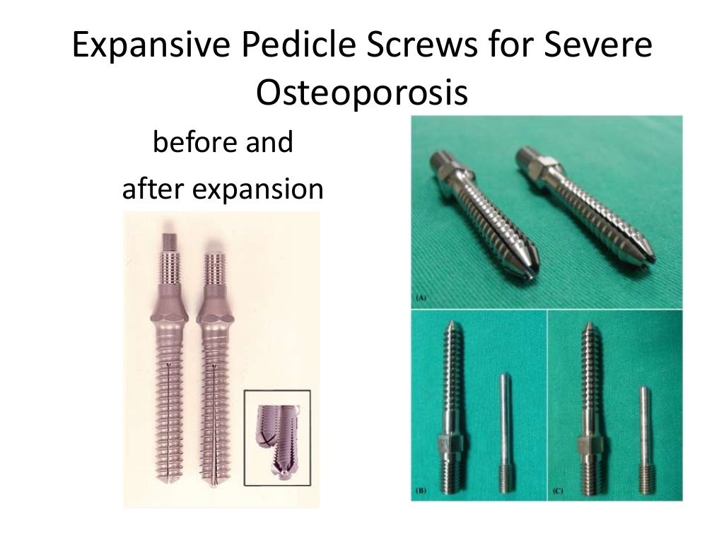 Pedicle screw fixation in osteoporotic fractures