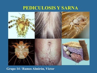 PEDICULOSIS Y SARNA 
Grupo 14 / Ramos Almirón, Víctor 
 