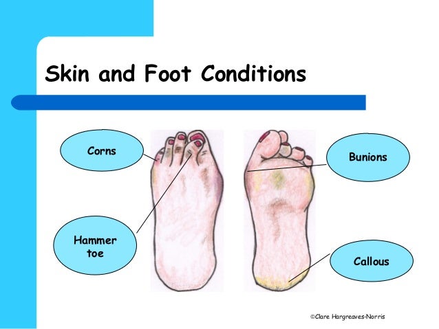 hard dry skin on big toe