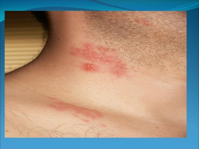 infectious diseases in children