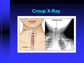 Croup X-Ray
 