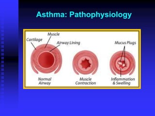 Asthma: Pathophysiology
 