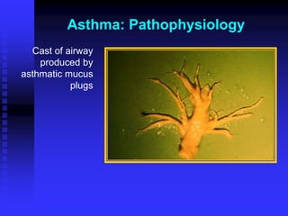 Asthma: Pathophysiology
Cast of airway
produced by
asthmatic mucus
plugs
 