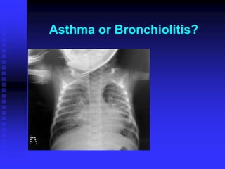 Asthma or Bronchiolitis?
 