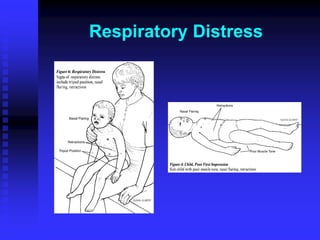 Respiratory Distress
 
