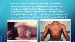 • Durante o período prodrômico, um a dois dias antes do
aparecimento do exantema, pode-se ter a presença das
manchas de Koplik (enantema fugaz, caracterizado por
pequenas manchas azul-esbranquiçadas no revestimento
interno das bochechas, mais comumente na região oposta aos
dentes molares), sinal patognomônico do sarampo (figura 6).
Na figura 7 apresentamos o exantema do sarampo em adulto.
 