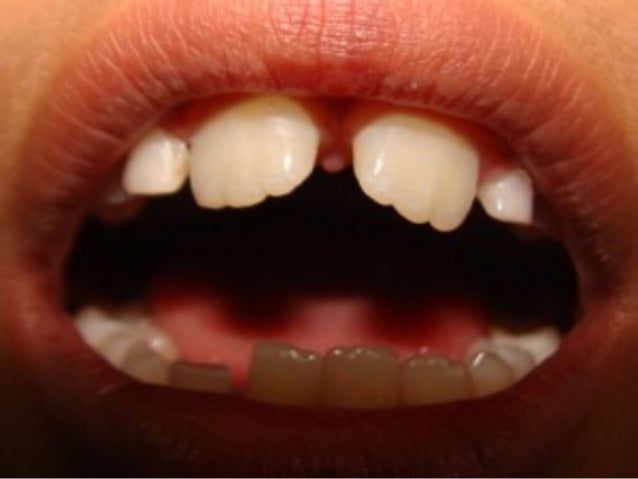 clinical features of mixed dentition period