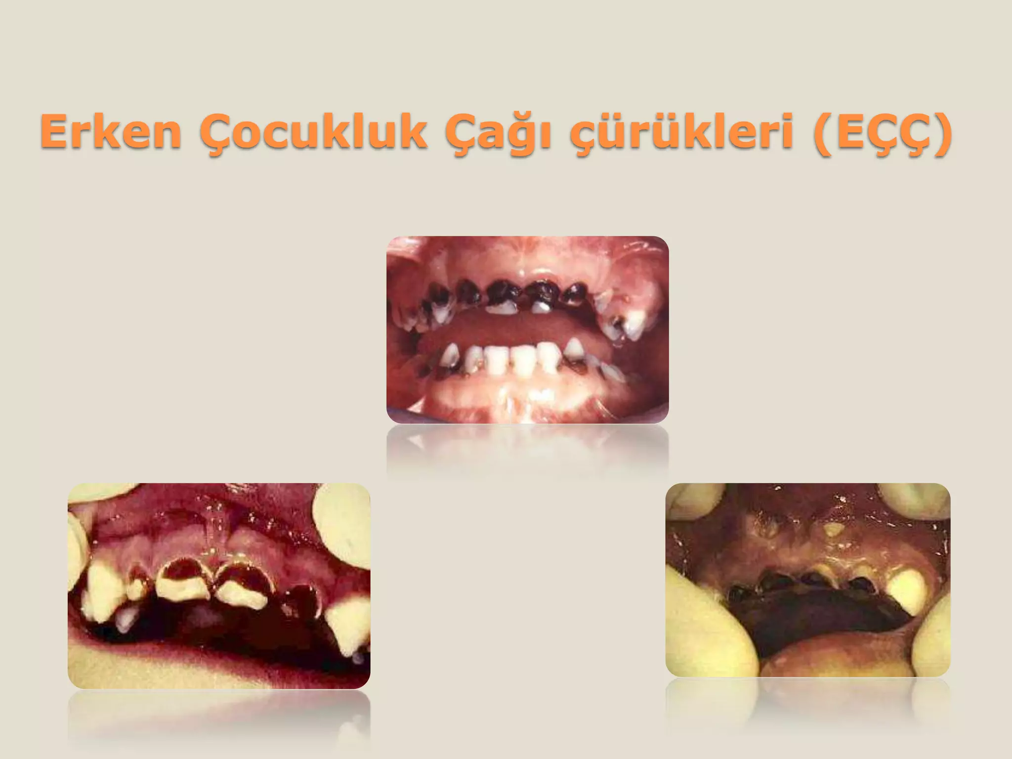 Erken Çocukluk Çağı çürükleri (EÇÇ)
 