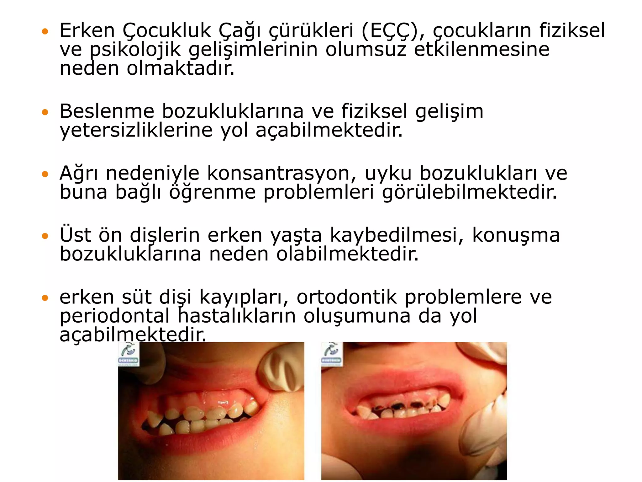  Erken Çocukluk Çağı çürükleri (EÇÇ), çocukların fiziksel
ve psikolojik gelişimlerinin olumsuz etkilenmesine
neden olmaktadır.
 Beslenme bozukluklarına ve fiziksel gelişim
yetersizliklerine yol açabilmektedir.
 Ağrı nedeniyle konsantrasyon, uyku bozuklukları ve
buna bağlı öğrenme problemleri görülebilmektedir.
 Üst ön dişlerin erken yaşta kaybedilmesi, konuşma
bozukluklarına neden olabilmektedir.
 erken süt dişi kayıpları, ortodontik problemlere ve
periodontal hastalıkların oluşumuna da yol
açabilmektedir.
 