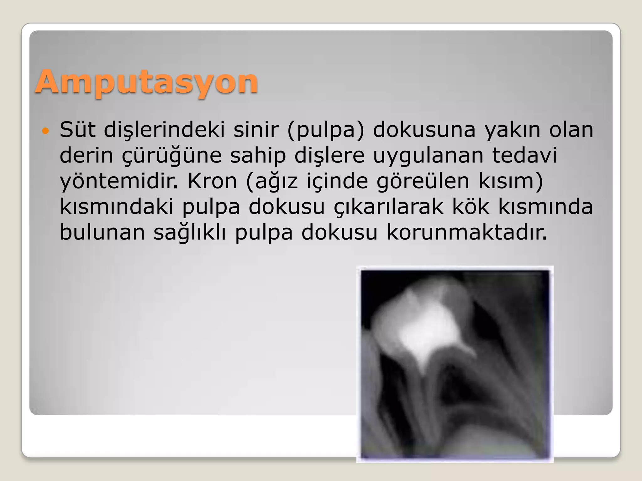 Amputasyon
 Süt dişlerindeki sinir (pulpa) dokusuna yakın olan
derin çürüğüne sahip dişlere uygulanan tedavi
yöntemidir. Kron (ağız içinde göreülen kısım)
kısmındaki pulpa dokusu çıkarılarak kök kısmında
bulunan sağlıklı pulpa dokusu korunmaktadır.
 