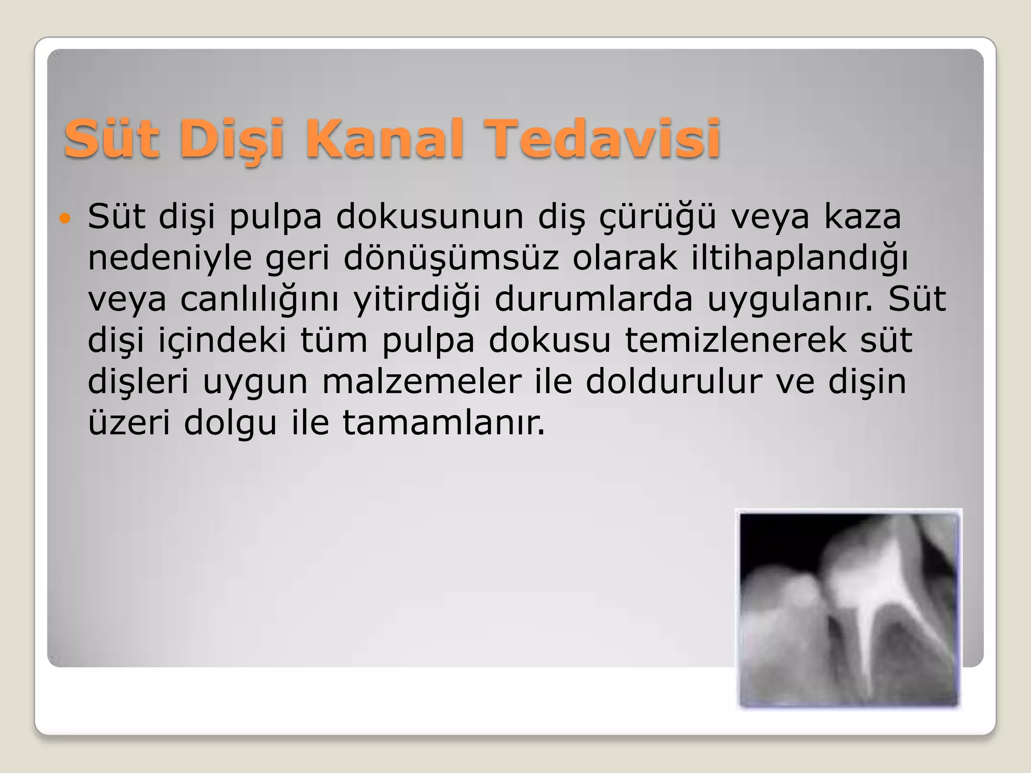 Süt Dişi Kanal Tedavisi
 Süt dişi pulpa dokusunun diş çürüğü veya kaza
nedeniyle geri dönüşümsüz olarak iltihaplandığı
veya canlılığını yitirdiği durumlarda uygulanır. Süt
dişi içindeki tüm pulpa dokusu temizlenerek süt
dişleri uygun malzemeler ile doldurulur ve dişin
üzeri dolgu ile tamamlanır.
 