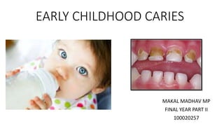 EARLY CHILDHOOD CARIES
MAKAL MADHAV MP
FINAL YEAR PART II
100020257
 