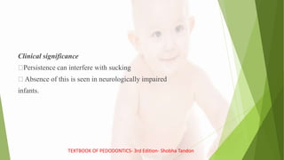 Clinical significance
Persistence can interfere with sucking
Absence of this is seen in neurologically impaired
infants.
TEXTBOOK OF PEDODONTICS- 3rd Edition- Shobha Tandon
 