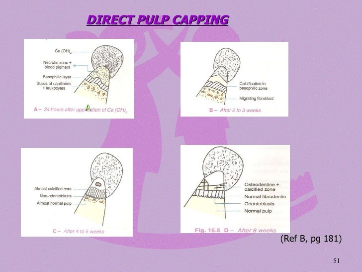 pulp therapy direct pulp capping
