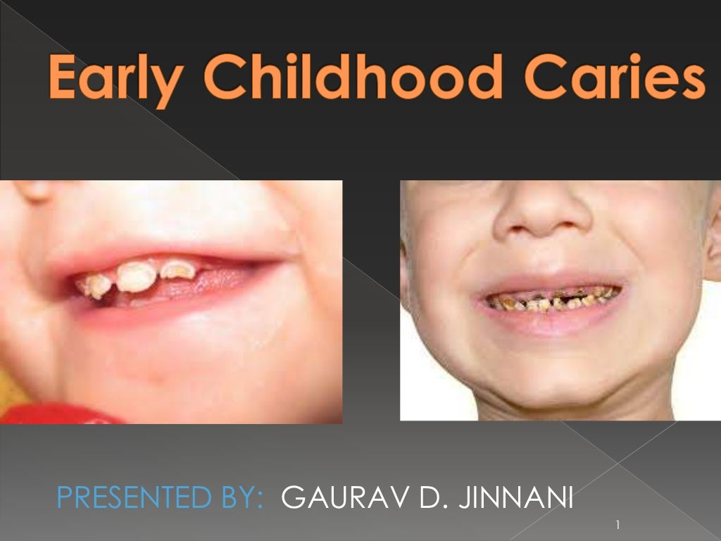 EARLY CHILDHOOD CARIES AND NURSING BOTTLE CARIES