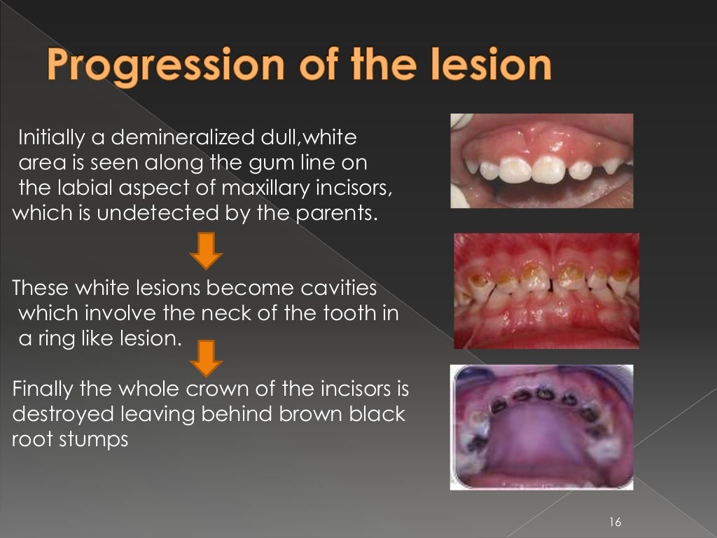 EARLY CHILDHOOD CARIES AND NURSING BOTTLE CARIES