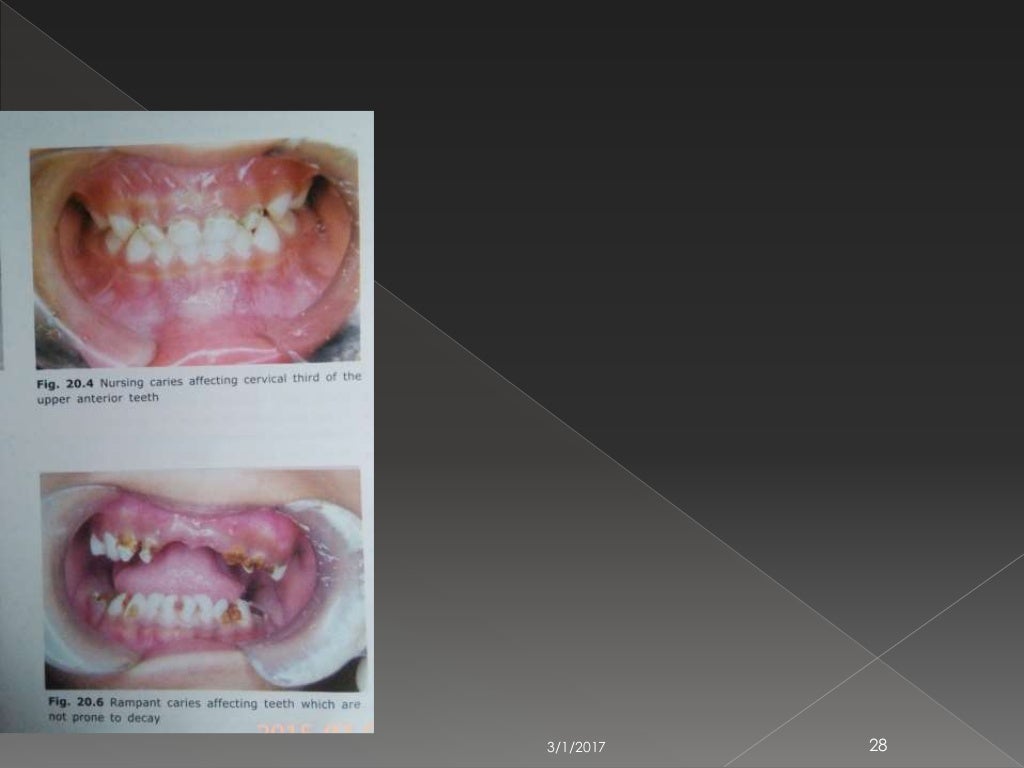 EARLY CHILDHOOD CARIES AND NURSING BOTTLE CARIES