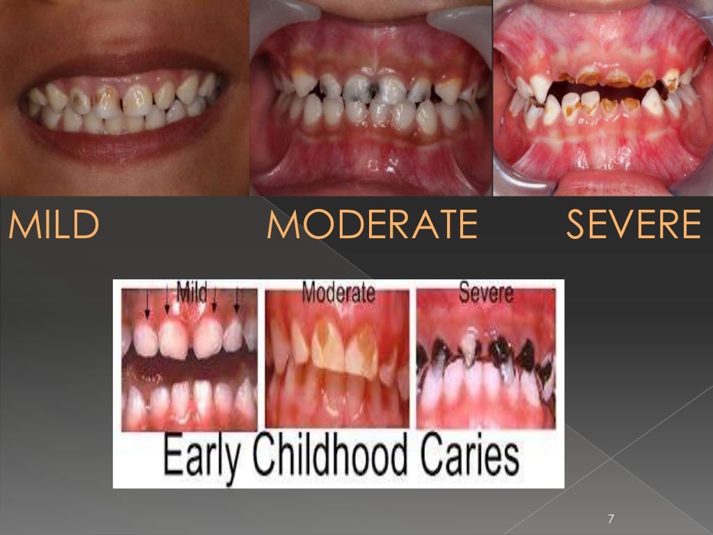 EARLY CHILDHOOD CARIES AND NURSING BOTTLE CARIES