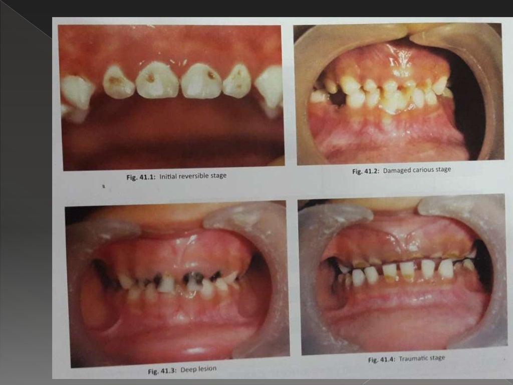 EARLY CHILDHOOD CARIES AND NURSING BOTTLE CARIES