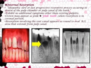 Internal Resorption
• “Idiopathic slow or fast progressive resorptive process occuring in
dentin of the pulp chamber or p...