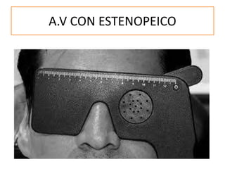 A.V CON ESTENOPEICO
 